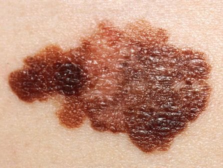 Cursos de auxiliar de enfermería melanoma